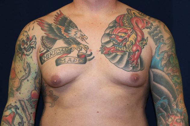 Male Breast Reduction* Case 6 - Before