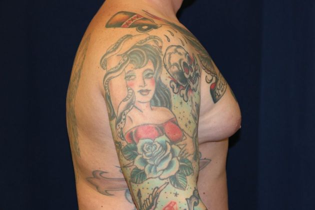 Male Breast Reduction*: Case 6 - Before