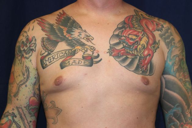 Male Breast Reduction* Case 6 - After