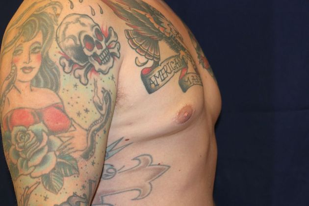 Male Breast Reduction*: Case 6 - After