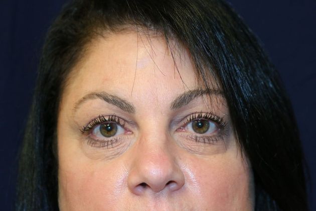 Eye Lift*: Case 1 - Before