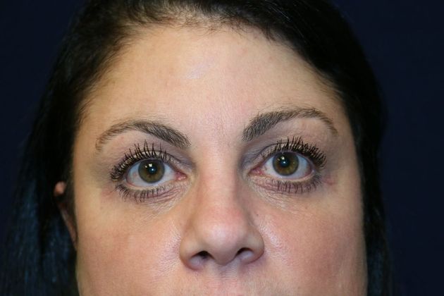 Eye Lift*: Case 1 - After
