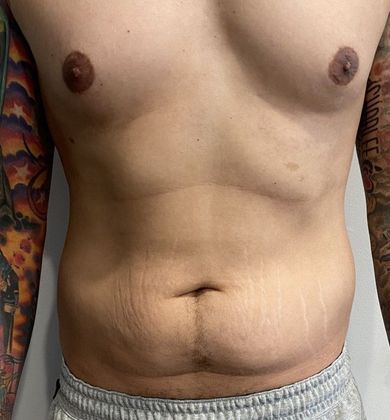 Tummy Tuck: Case 22 Male Mini Tummy Tuck Norwalk, CT - Before