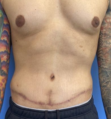 Tummy Tuck: Case 22 Male Mini Tummy Tuck Norwalk, CT - After