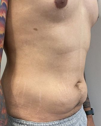 Tummy Tuck: Case 22 Male Mini Tummy Tuck Norwalk, CT - Before