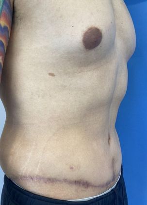 Tummy Tuck: Case 22 Male Mini Tummy Tuck Norwalk, CT - After