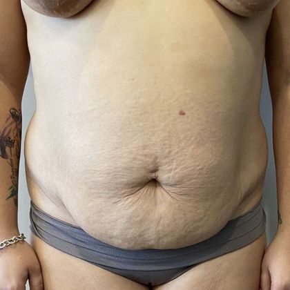 Tummy Tuck: Case 23 Tummy Tuck Darien, CT - Before