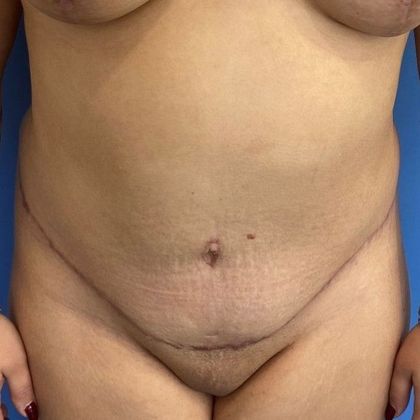 Tummy Tuck: Case 23 Tummy Tuck Darien, CT - After