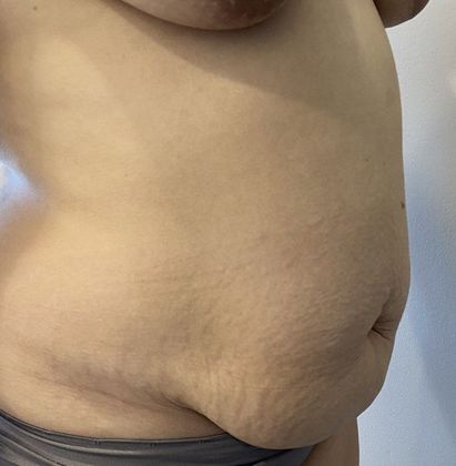 Tummy Tuck: Case 23 Tummy Tuck Darien, CT - Before