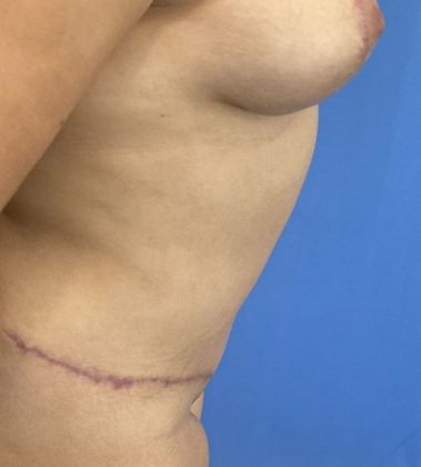 Tummy Tuck: Case 23 Tummy Tuck Darien, CT - After