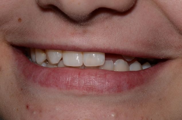 Dental Implants: Case 45 - Before