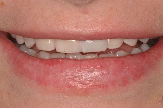 Dental Implants: Case 45 - After