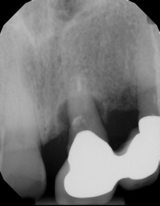 Dental Implants: Case 46 - Before