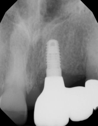 Dental Implants: Case 46 - After