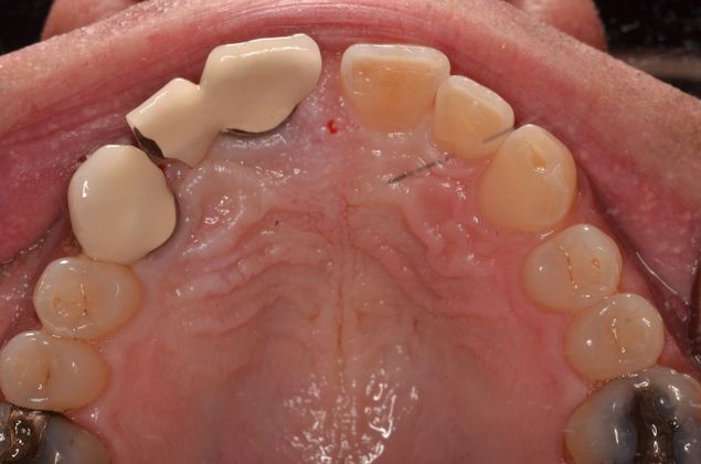 Dental Implants: Case 46 - Before