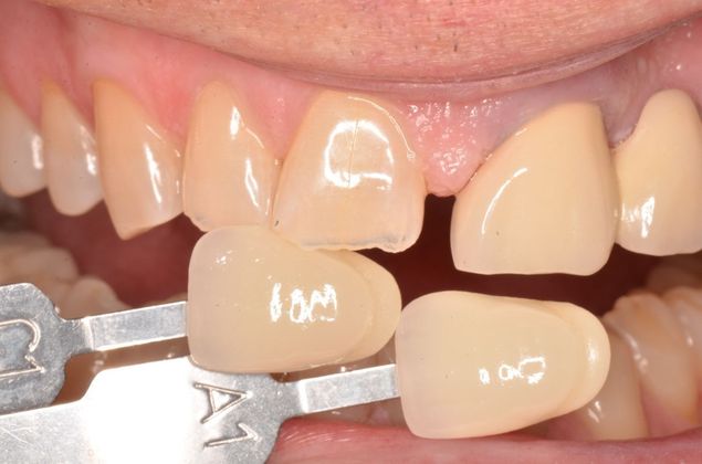 Dental Implants: Case 46 - Before
