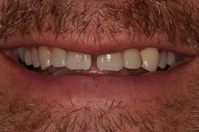 Dental Implants: Case 46 - After