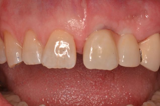 Dental Implants: Case 46 - After