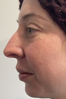 Rhinoplasty: Case 23 Rhinoplasty Trumbull, CT - Before