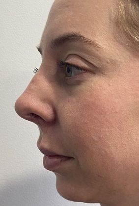 Rhinoplasty: Case 23 Rhinoplasty Trumbull, CT - After