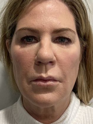 Facelift: Case 26 Facelift, Necklift, Eyelid Lift Greenwich, CT - Before