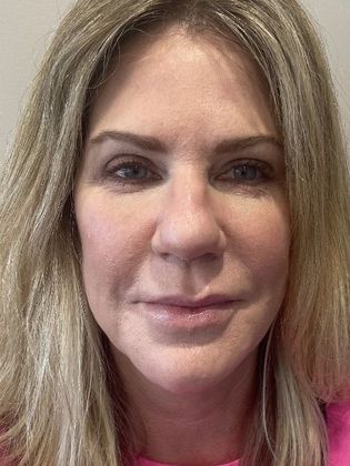 Facelift: Case 26 Facelift, Necklift, Eyelid Lift Greenwich, CT - After