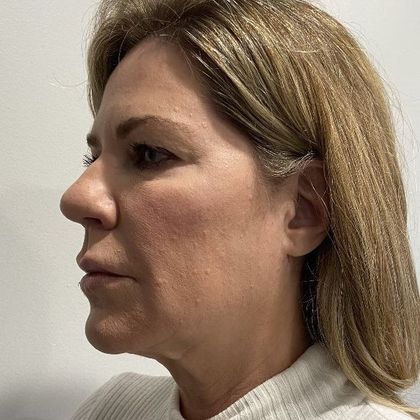 Facelift: Case 26 Facelift, Necklift, Eyelid Lift Greenwich, CT - Before