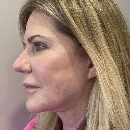 Facelift: Case 26 Facelift, Necklift, Eyelid Lift Greenwich, CT - After