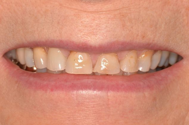 Porcelain Veneers: Case 24 - Before