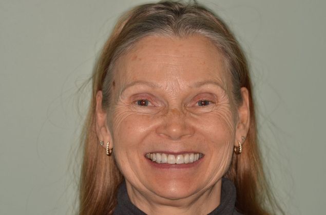 Porcelain Veneers: Case 24 - After