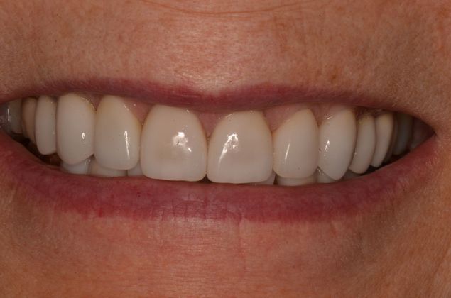 Porcelain Veneers: Case 24 - After