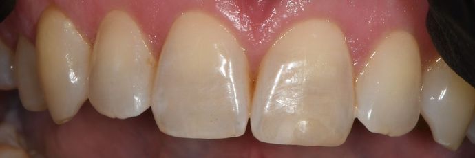 Tooth-colored Fillings Case 17 - Victoria, TX - After