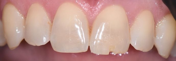 Tooth-colored Fillings Case 17 - Victoria, TX - Before