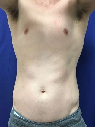 Cooltone Muscle Stimulation: Case 3 - After,flexing