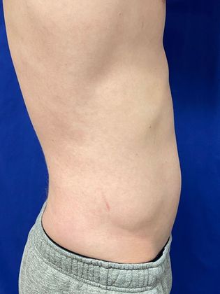 Cooltone Muscle Stimulation: Case 3 - Before,right lateral