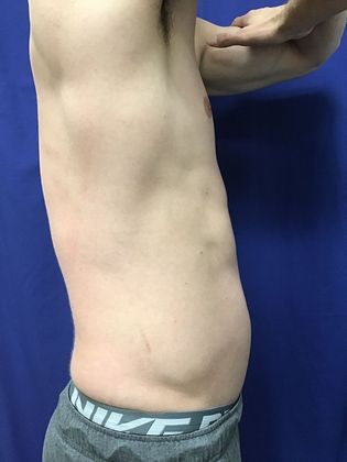 Cooltone Muscle Stimulation: Case 3 - After,right lateral