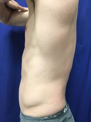 Cooltone Muscle Stimulation: Case 3 - After