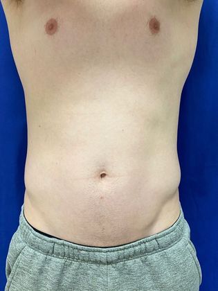 Cooltone Muscle Stimulation: Case 3 - Before,flexing