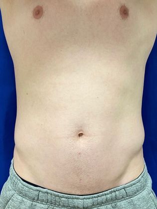 Cooltone Muscle Stimulation: Case 3 - Before,relaxed