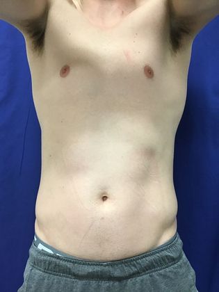 Cooltone Muscle Stimulation: Case 3 - After,relaxed