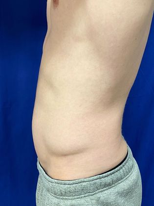 Cooltone Muscle Stimulation: Case 3 - Before