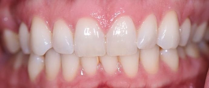 Braces Case 3 - Cuero, TX - Before