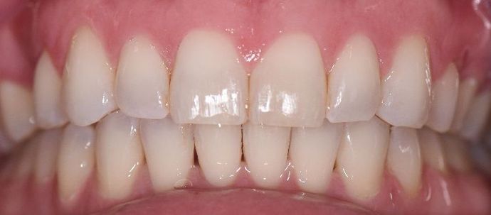 Braces Case 3 - Cuero, TX - After