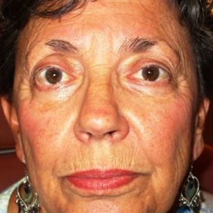 Permanent MakeUp Case 36 - Before