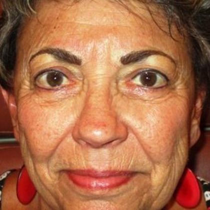 Permanent MakeUp Case 36 - After