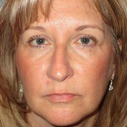 Permanent MakeUp Case 37 - Before