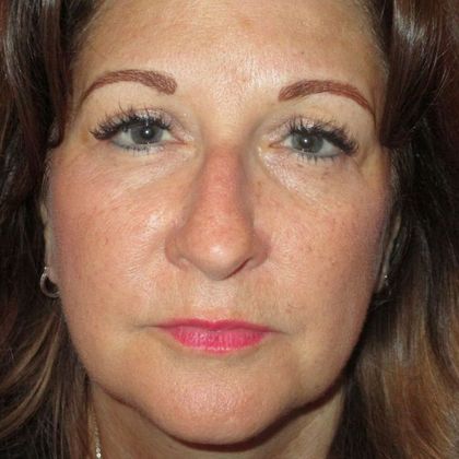 Permanent MakeUp Case 37 - After