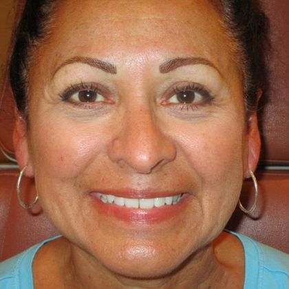 Permanent MakeUp Case 38 - After