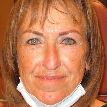 Permanent MakeUp Case 39 - After