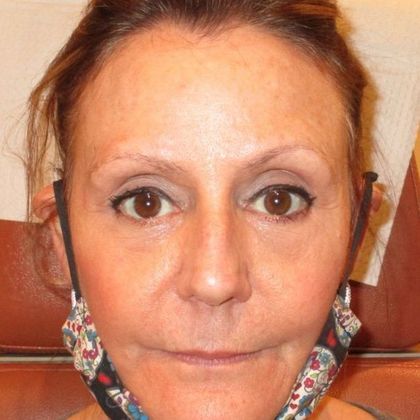 Permanent MakeUp PMU Before and After - Before